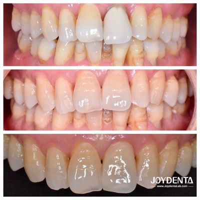 Buy Premium Zirconium Crowns | Global Dental Lab Outsourcing | JOY Dental Lab online manufacture
