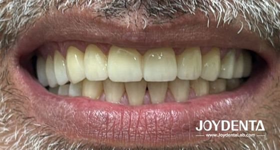 Buy Zirconia dentures that imitate natural teeth online manufacture