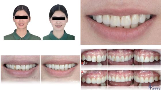 Buy Joydentalab's popular products: Simulated aesthetic veneers online manufacture