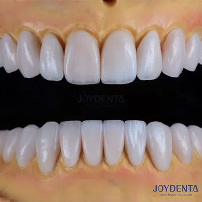 Buy Custom Crafted Emax Porcelain Veneers Smooth Texture Dental Restorations online manufacture