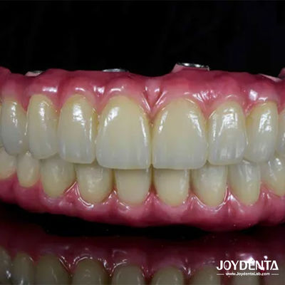 Buy Lightweight Dental Titanium Malong Hybrid Bridge Comfortable For Dental Restoration online manufacture