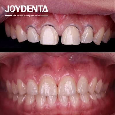 Buy Cosmetic Dentistry Dental Veneers Lab | Premium Porcelain & Composite Veneers Outsourcing - Joydentalab online manufacture