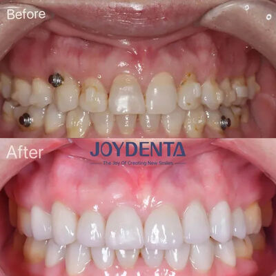 Buy Dental Veneers for Missing Teeth | Global Premium Dental Lab Services online manufacture