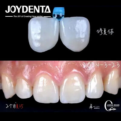 Buy Anterior Tooth Indication Dental Veneers With No Preparation Needed And No Discoloration online manufacture