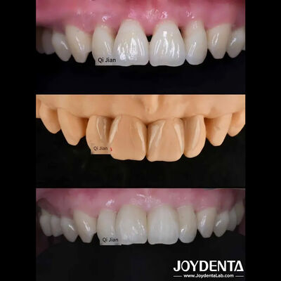 Buy Grassshopper Veneers The Perfect Solution For Natural Translucency Dental Veneers online manufacture