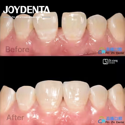 Buy Secure Fit Porcelain Veneers Dental Treatment Composite Resin Veneers Stain Resistant online manufacture