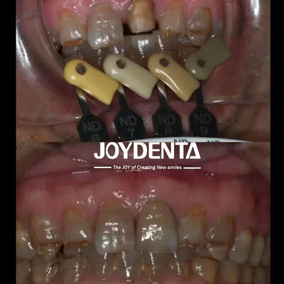 Buy Translucency Zirconia Crowns Multilayered Gradient Technology online manufacture