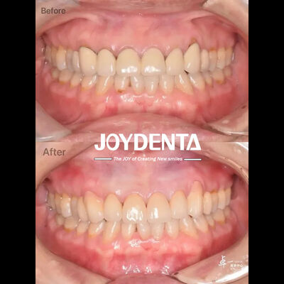 Buy Dental Zirconia For Safe Oral Tissue And CAD / CAM Compatibility online manufacture