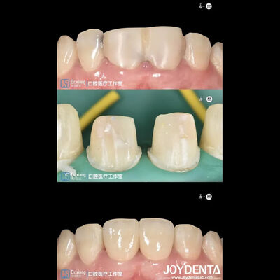 Buy Perfectly Fit teeth Zirconia Dental Crowns With CAD CAM Systems online manufacture