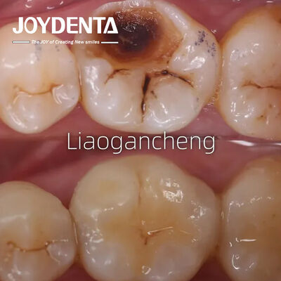 Buy Porcelain Dental Inlay Restorative For Adults And Children Exceptional Performance online manufacture