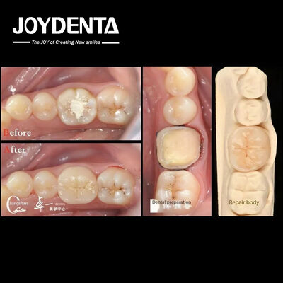 Buy Biocompatibility And High Compatibility With Natural Teeth Restoration online manufacture