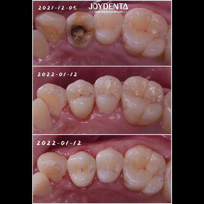 Buy Accurate Fit Dental Porcelain Inlay Damaged Teeth Restoration online manufacture