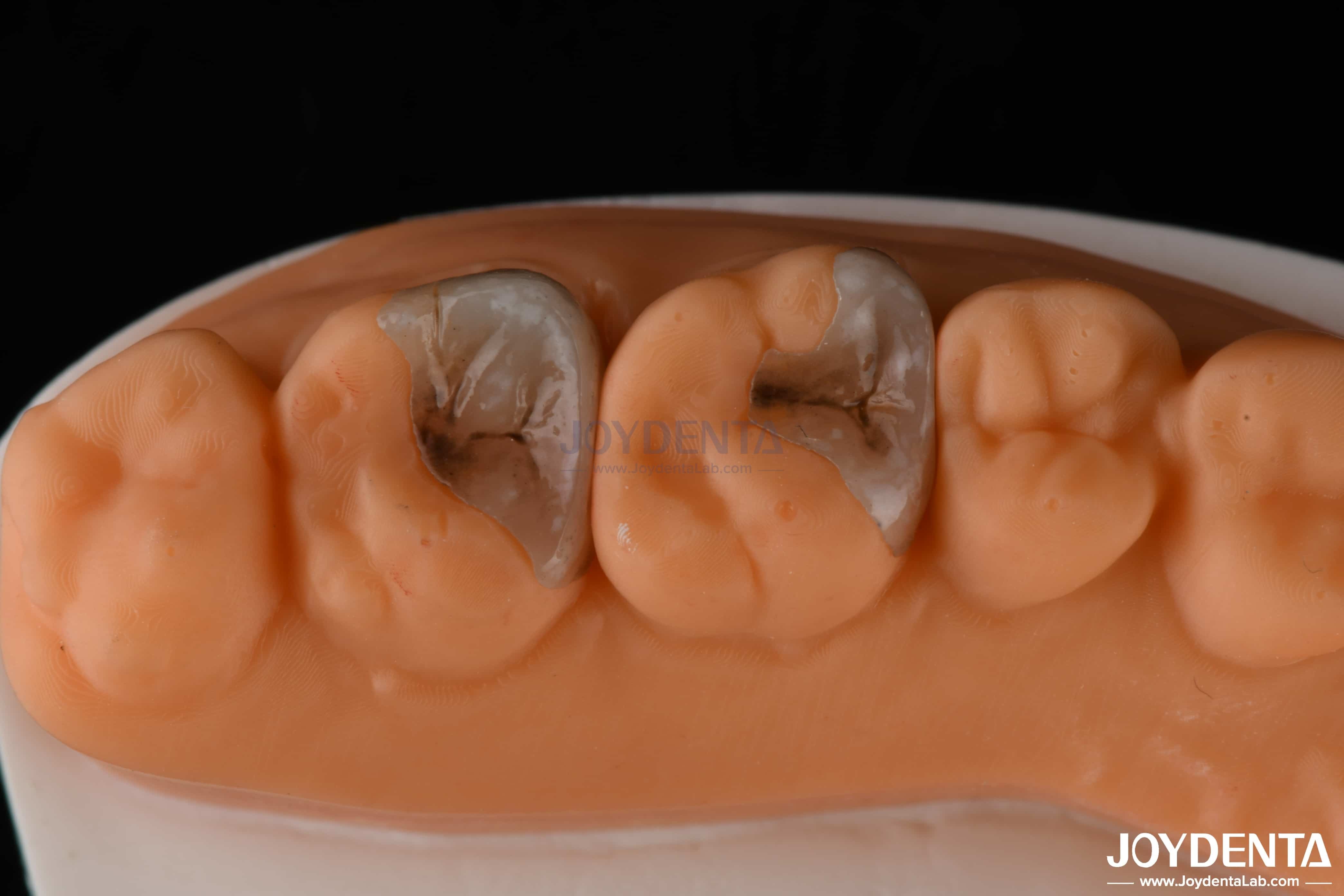 Composite Inlays And Onlays For Dental Restoration Strong Bonding To ...