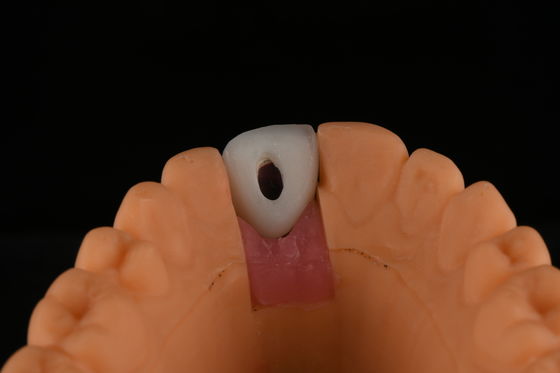 Roughened Surface Titanium Dental Implants Surgery For Front Tooth Replacement