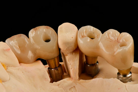 Self Tapping 3.0mm Thread Dental Titanium Implant Optimized Functionality