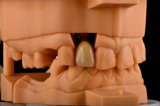 Internal Hex 3.0mm Depth 1.5mm Pitch Single Titanium Tooth Implant Replacement