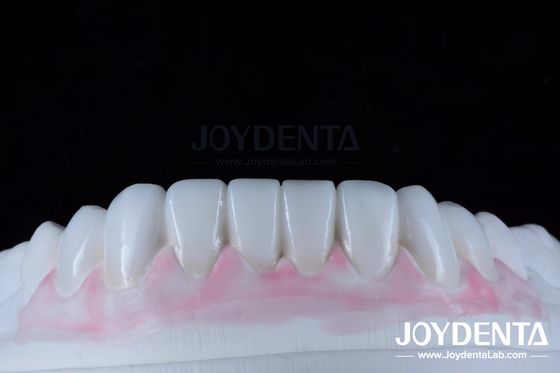 Customized Digital Diagnostic Wax Ups for Natural Tooth Anatomy Replication