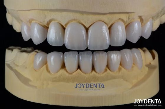 Advanced Ceramic Porcelain Veneers Biocompatible Shade Matched for a Natural Smile