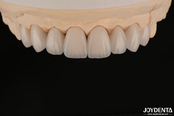 Smooth And Lightweight Dental Veneers Biocompatible And Comfortable For Oral Health