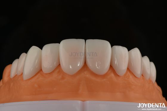 Optimal Patient Comfort With Porcelain Veneers Biocompatible And Gentle On Oral Tissues