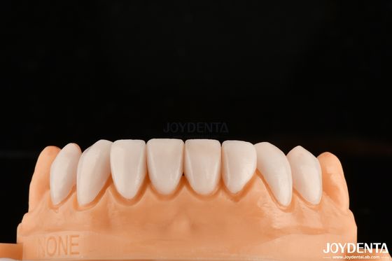 Strong Bond With Tooth Enamel For Secure Fit Dental Veneers Customization For Personalized Shades To Match Natural Teeth