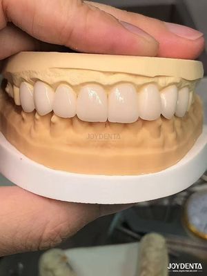 Customized Shades To Match Natural Teeth Biocompatible And Stain Resistant Dental Veneers