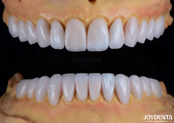 Stain Resistance and Brightness Maintenance Dental Veneers for Chipped Teeth Transformation Guarantee