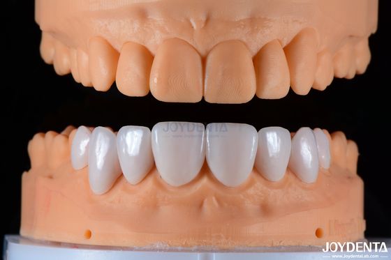 Secure Fit Porcelain Veneers Ceramic and Natural Aesthetics with Strong Adhesion
