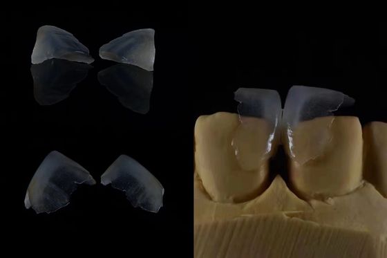 Comfortable Dental Veneers Strong Bond With Tooth Enamel For Secure Fit Lightweight And Smooth For Optimal Patient Comfort