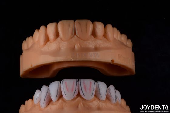 Custom Made Dental Emax Ceramic Veneers With Stain Resistance High Gloss