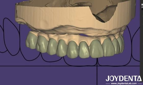 Individualized Design Digital Diagnostic Wax Up Lab Software Seamless Integration