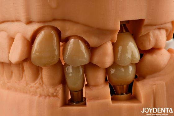 Customizable Implant Crown and Bridge Achieve a Natural Look with Long-lasting Results