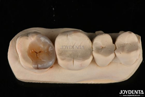 Custom Natural Looking Emax Dental Inlays And Onlays For Tooth Restoration