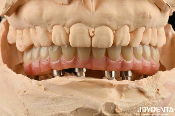 Aesthetic Titanium Malong Hybrid Dental Implant Bridge For Dental Perfection