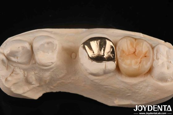 Custom Oral Clinical Wear Resistant Gold Dental Crown With 60K Metallic