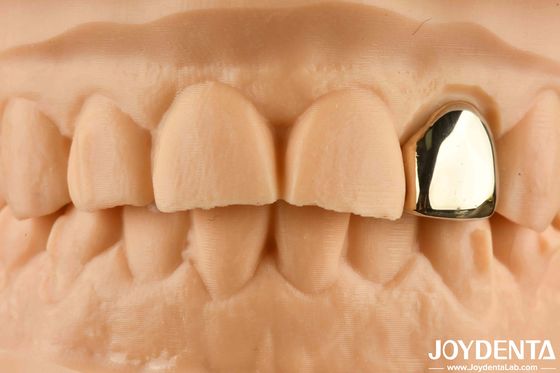 Gold 60K Metallic Oral Crown Abrasion Resistant Dental Crown Wax Casting