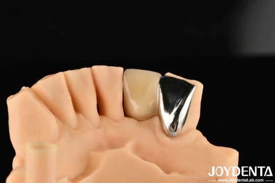 Dental Metal / Maryland Bridege Oral Clinical Repair Metallic Ideal Color Clinical Bonding