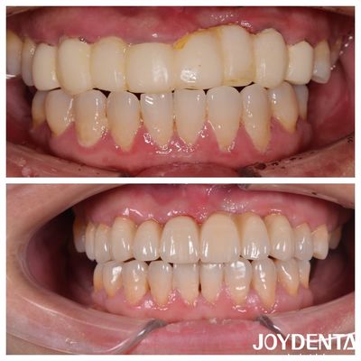 Natural Color Multilayer Dental Zirconia Bridges For Optimal Patient Experience
