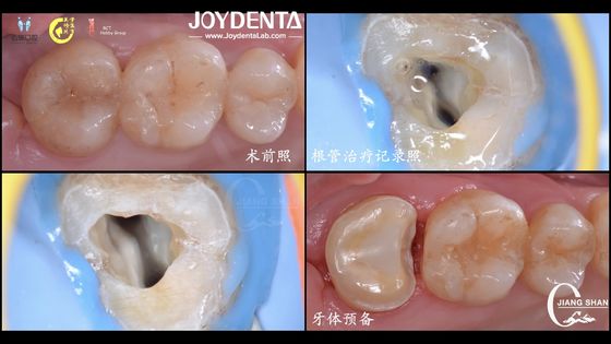 Long Lasting Natural Looking dental ceramic inlay Precise Fit High Compatibility