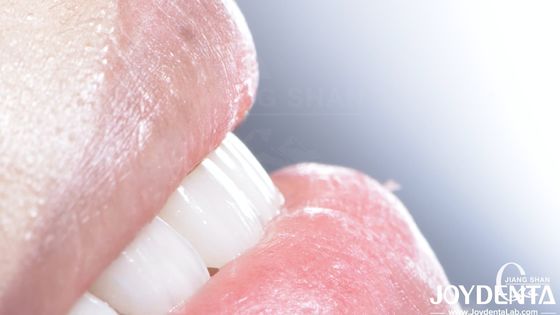 Long Lasting Dental Composite Veneer Good Biocompatibility No Drop Off porcelain veneers