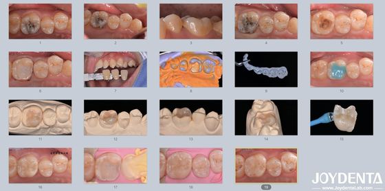 Adults Children Porcelain Ceramic Dental Inlay Restorative for Damaged Teeth