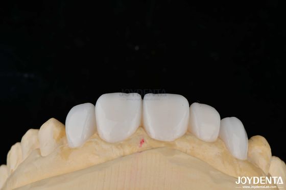 Customization Porcelain Material Emax Teeth Veneers For High Aesthetics Bonding