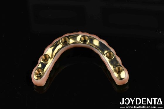 Custom-made Ti-Bar Zirconia Hybrid Bridge For Comfort And Durability In Dental Restorations
