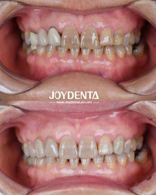 Lightweight Dental Zirconia For Optimal Patient Experience Natural Color Transitions And Biocompatibility Guaranteed