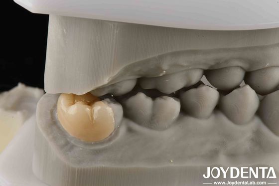 High Strength Emax Good Transparency Emax Inlay Onlay For Transparent Performance