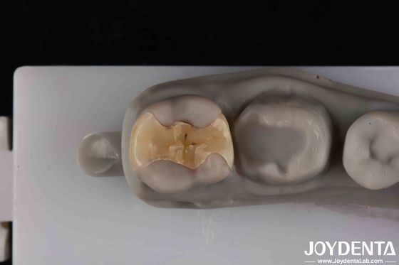Low Translucency Inlay Onlay Secure Cementation For Long-Lasting And Aesthetic Restorations