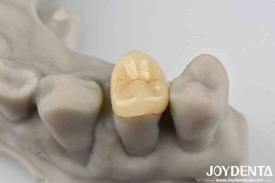 Secure Cementation Emax Inlay Onlay Easy To Clean And Resistant To Staining