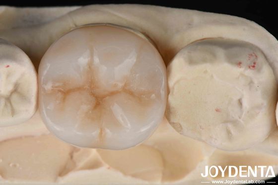 Multilayer Full Zirconia Ultimate Combination Of Strength And Aesthetics For Dental Restorations