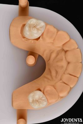 Natural-looking Esthetics With Biocompatible Dental Zirconia  Winning Combination