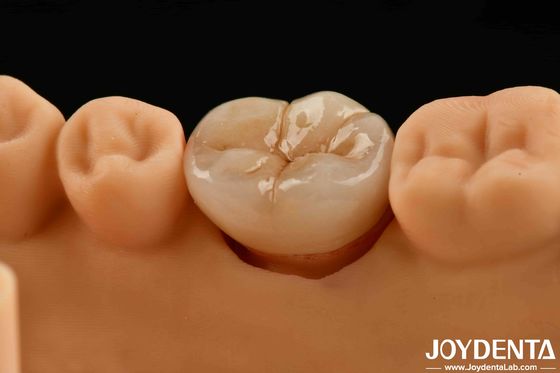 Natural-looking Multilayer Full Zirconia For High Strength And Durability